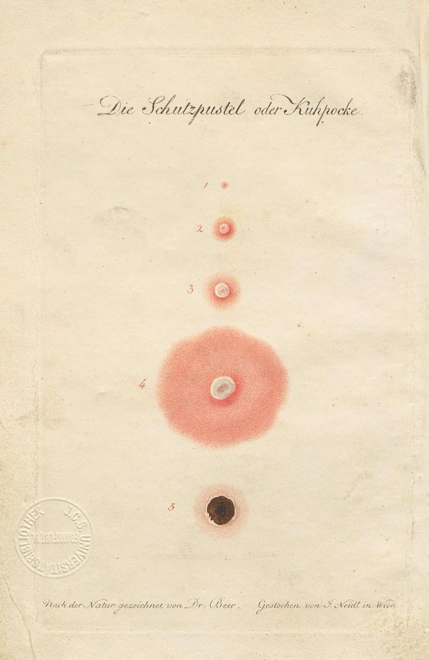 Mehrere Stiche einer Schutzpustel, deren roter Rand über die Tage hinweg immer größer wird, bis sie schließlich abstirbt